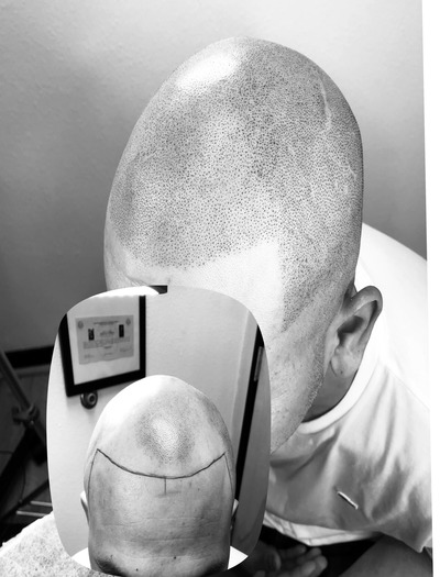 scalp micropigmentation Austin