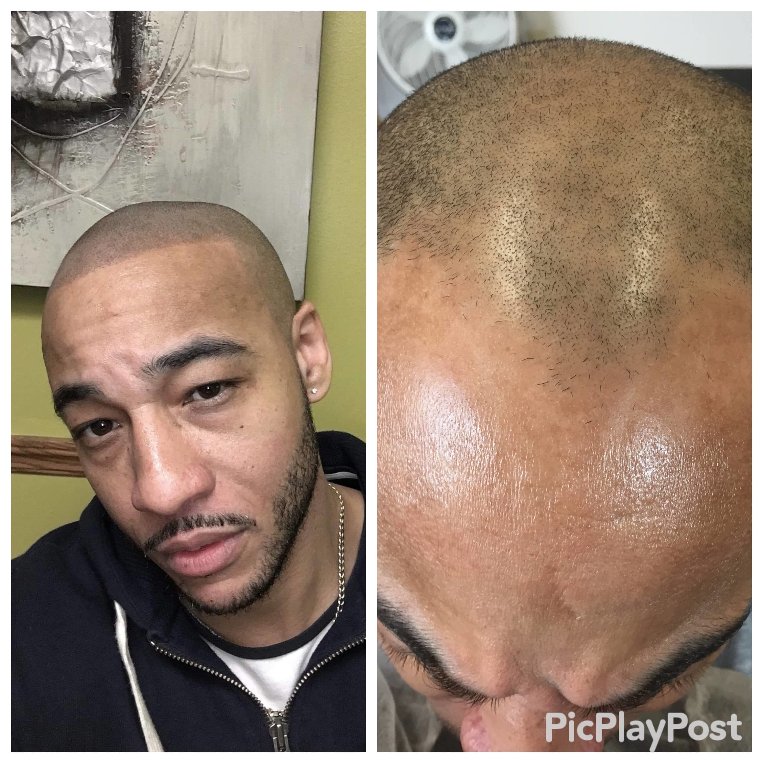 Scalp Micropigmentation Clinic In Austin Texas 1 Hair Loss Solution Ink Scalp Goddess