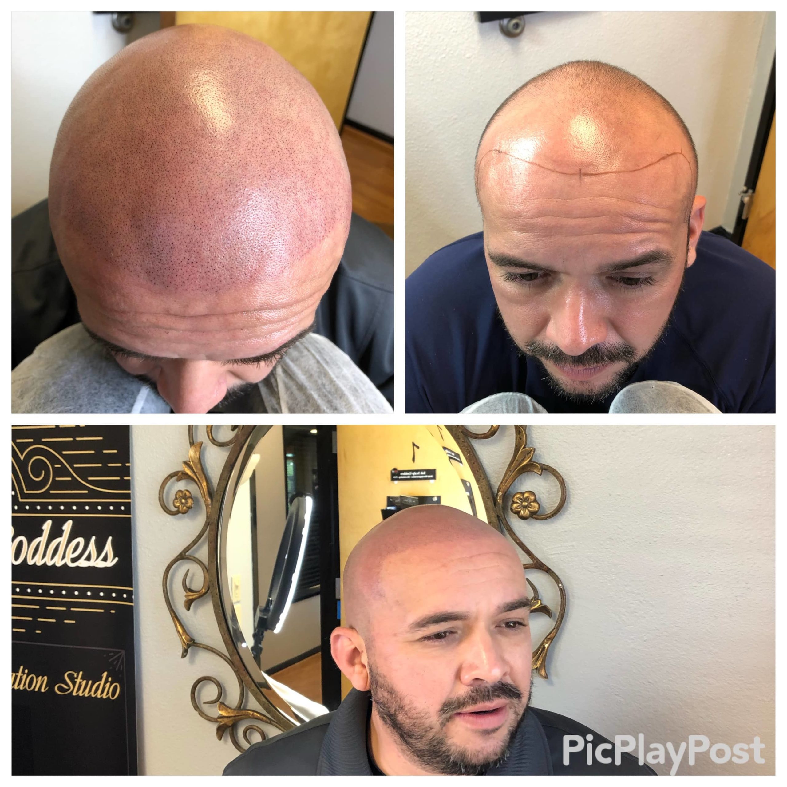 Scalp Micropigmentation Clinic In Austin Texas 1 Hair Loss Solution Ink Scalp Goddess