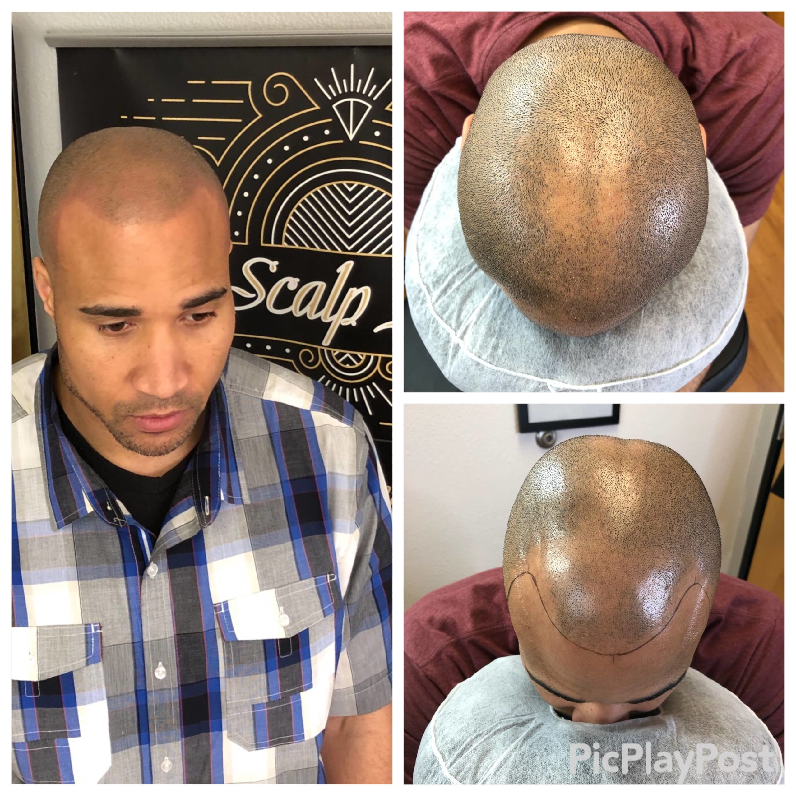 Scalp Micropigmentation Clinic In Austin Texas 1 Hair Loss Solution Ink Scalp Goddess