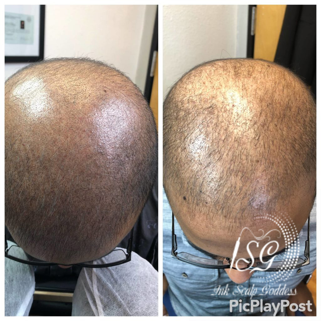 Say Goodbye to Hair Loss Anxiety: How Scalp Micropigmentation Can Help