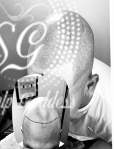 The Science Behind Scalp Micropigmentation: A Comprehensive Overview