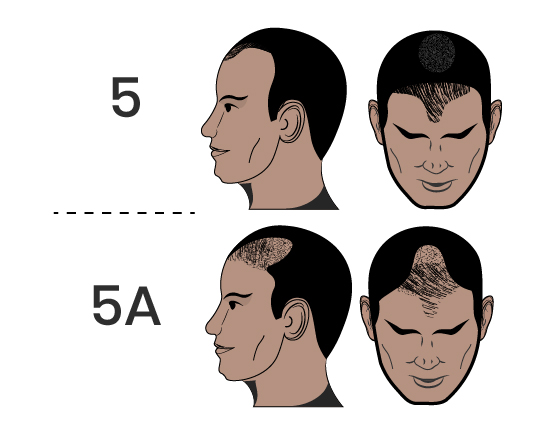 Natural Hairlines, Real Results: Exploring Scalp Micropigmentation