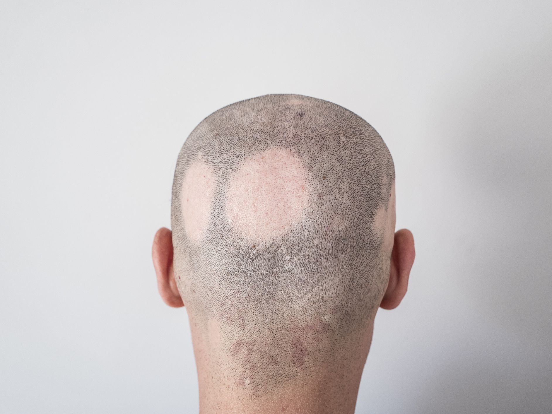 Alopecia